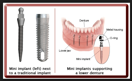 mini dental implant for dentures vs traditional dental implants