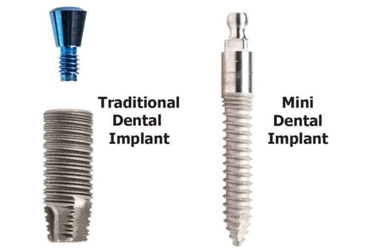 mini dental implant vs traditional dental implant