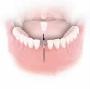 mini dental implant_single tooth